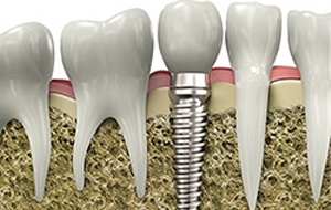 Animation of implant supported crown