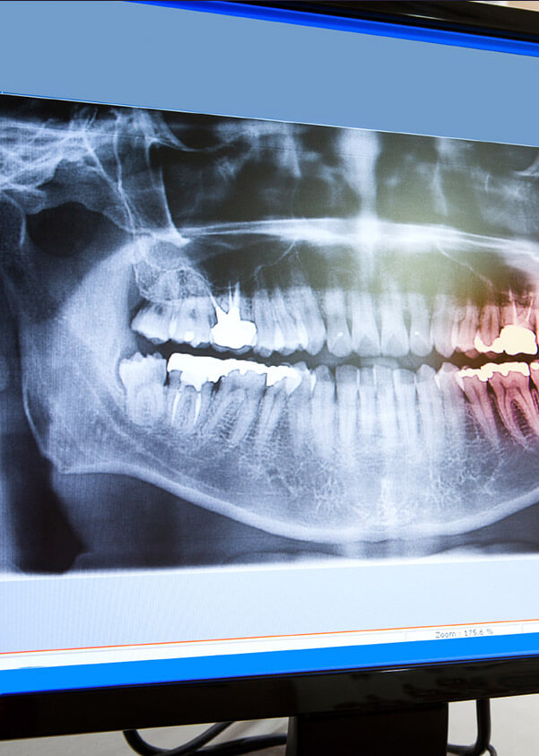 Panoramic dental x-rays